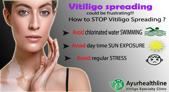 how to stop vitiligo from spreading