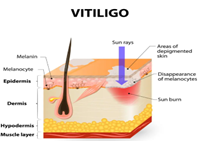 anti vitiligo kit melanin production