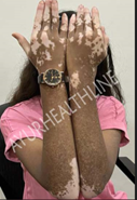vitiligo cure results ayurhealthline