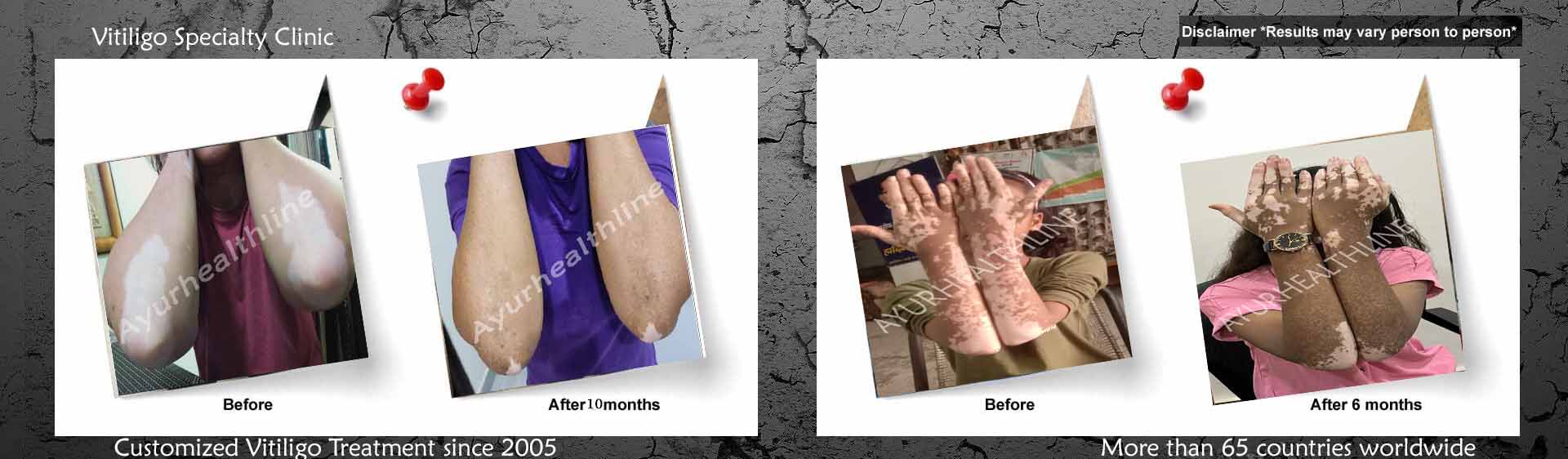 Anti vitiligo kit treatment for vitiligo in Ayurveda