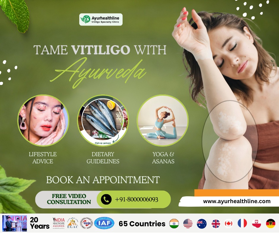 how to cure vitiligo