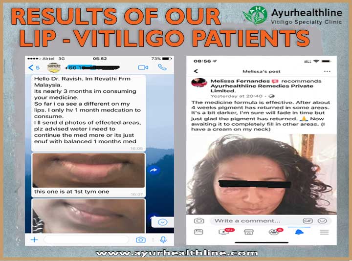 lips vitiligo treatment in ayurveda