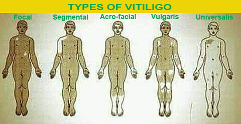 types of vitiligo