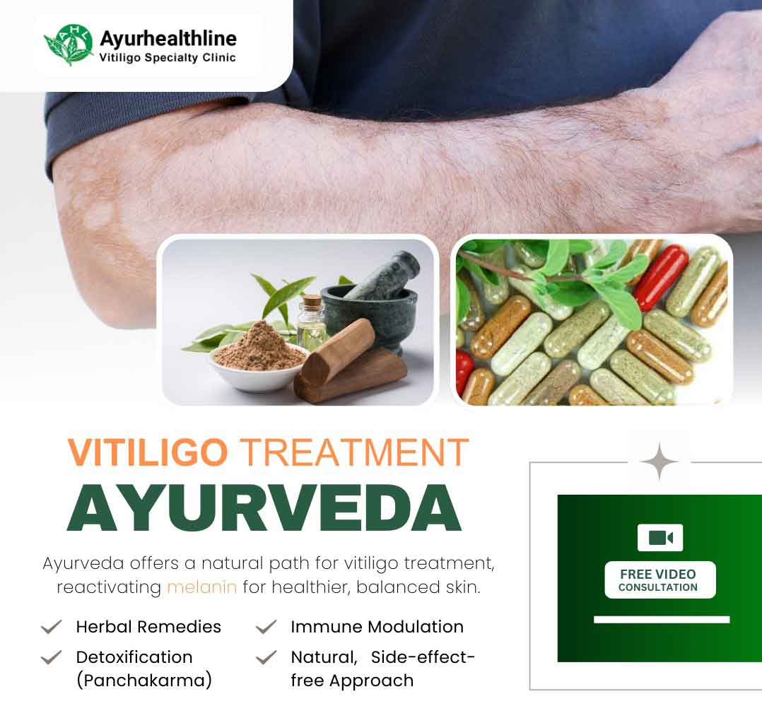 vitiligo treatment in ayurveda