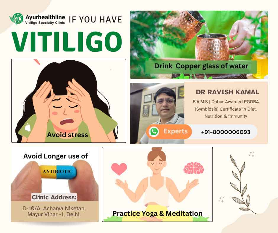 vitiligo treatment in ayurveda by Ayurhealthline, vitiligo treatment, ayurvedic vitiligo treatment