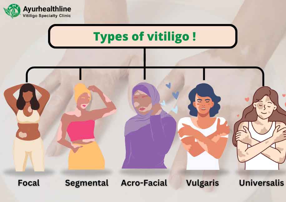types of vitiligo treatment in ayurveda