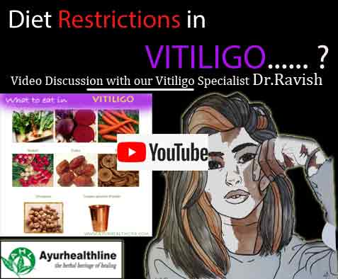 vitiligo treatment discussion