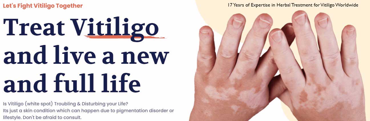 vitiligo natural treament , vitiligo herbal treatment, herbs for vitiligo